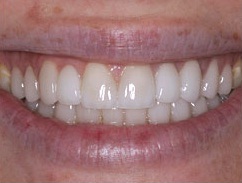 porcelain veneer